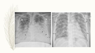 Chest x ray interpretation of infections [autosaved] | PPTX