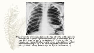 Chest x ray interpretation of infections [autosaved] | PPTX