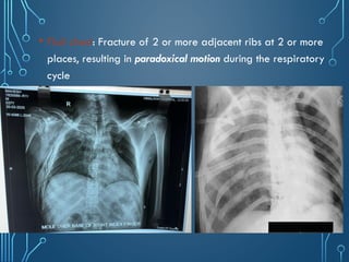 Chest_xray_in_trauma and trauma[PS].pptx