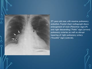 Chest_xray_in_trauma and trauma[PS].pptx