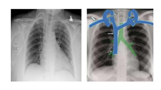 Ppt on chest xray lines and tubes (1).pptx