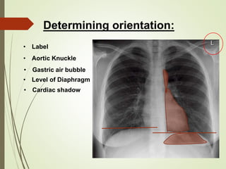 Aortic Shadow Chest Xray - How to read & interpret | PPTX