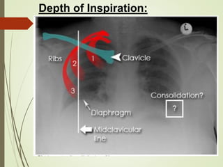 Chest Xray - How to read & interpret | PPTX