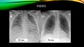 Chest XRAY -anatomy Dr.SALBIA XAVIER K | PPTX