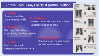 Chest XRay Normal vs Abnormal A Complete Visual Guide By Durjay Laha ...