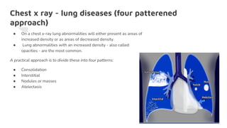 Chest x ray - lung diseases (four patterened
approach)
● On a chest x-ray lung abnormalities will either present as areas of
increased density or as areas of decreased density.
● Lung abnormalities with an increased density - also called
opacities - are the most common.
A practical approach is to divide these into four patterns:
● Consolidation
● Interstitial
● Nodules or masses
● Atelectasis
 
