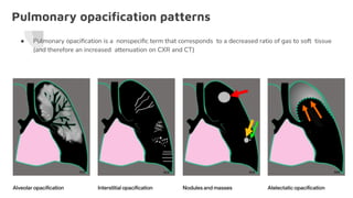 Pulmonary opaciﬁcation patterns
● Pulmonary opaciﬁcation is a nonspeciﬁc term that corresponds to a decreased ratio of gas to soft tissue
(and therefore an increased attenuation on CXR and CT)
 