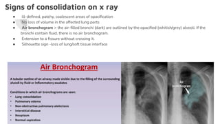Signs of consolidation on x ray
● ill-deﬁned, patchy, coalescent areas of opaciﬁcation
● No loss of volume in the affected lung parts
● Air bronchogram > the air-ﬁlled bronchi (dark) are outlined by the opaciﬁed (whitish/grey) alveoli. If the
bronchi contain ﬂuid, there is no air bronchogram.
● Extension to a ﬁssure without crossing it.
● Silhouette sign -loss of lung/soft tissue interface
 
