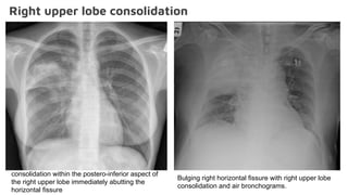 Right upper lobe consolidation
Bulging right horizontal fissure with right upper lobe
consolidation and air bronchograms.
consolidation within the postero-inferior aspect of
the right upper lobe immediately abutting the
horizontal fissure
 