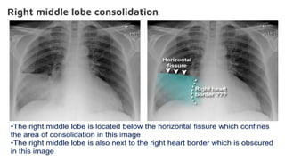 Right middle lobe consolidation
 