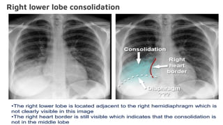 Right lower lobe consolidation
 
