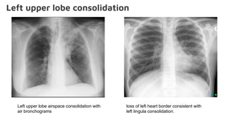 Left upper lobe consolidation
loss of left heart border consistent with
left lingula consolidation.
Left upper lobe airspace consolidation with
air bronchograms
 