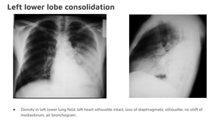 Left lower lobe consolidation
● Density in left lower lung ﬁeld, left heart silhouette intact, loss of diaphragmatic silhouette, no shift of
mediastinum, air bronchogram.
 