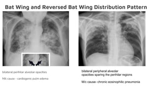 Bat Wing and Reversed Bat Wing Distribution Pattern
bilateral perihilar alveolar opacities
M/c cause - cardiogenic pulm edema
bilateral peripheral alveolar
opacities sparing the perihilar regions
M/c cause- chronic eosinophilic pneumonia
 