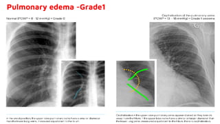 Pulmonary edema -Grade1
 