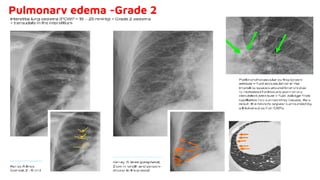 Pulmonary edema -Grade 2
 