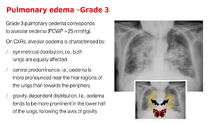 Pulmonary edema -Grade 3
 