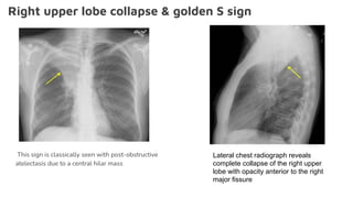 Right upper lobe collapse & golden S sign
This sign is classically seen with post-obstructive
atelectasis due to a central hilar mass
Lateral chest radiograph reveals
complete collapse of the right upper
lobe with opacity anterior to the right
major fissure
 