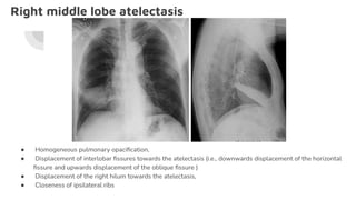 Right middle lobe atelectasis
● Homogeneous pulmonary opaciﬁcation,
● Displacement of interlobar ﬁssures towards the atelectasis (i.e., downwards displacement of the horizontal
ﬁssure and upwards displacement of the oblique ﬁssure )
● Displacement of the right hilum towards the atelectasis,
● Closeness of ipsilateral ribs
 