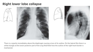 Right lower lobe collapse
There is a opacity immediately above the diaphragm causing a loss of its outline. On the lateral ﬁlm there is a
white triangle at the lower posterior part of the lung ﬁeld.Note how the outline of the right heart border is
maintained.
 