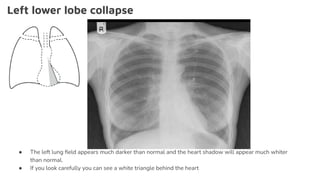 Left lower lobe collapse
● The left lung ﬁeld appears much darker than normal and the heart shadow will appear much whiter
than normal.
● If you look carefully you can see a white triangle behind the heart
 