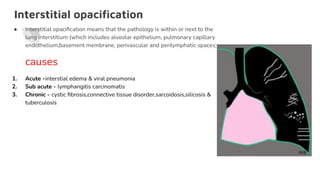 Interstitial opaciﬁcation
● Interstitial opaciﬁcation means that the pathology is within or next to the
lung interstitium (which includes alveolar epithelium, pulmonary capillary
endothelium,basement membrane, perivascular and perilymphatic spaces).
causes
1. Acute -interstial edema & viral pneumonia
2. Sub acute - lymphangitis carcinomatis
3. Chronic - cystic ﬁbrosis,connective tissue disorder,sarcoidosis,silicosis &
tuberculosis
 