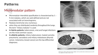 Patterns
Micronodular pattern
● Micronodular interstitial opaciﬁcation is characterised by 1 -
5 mm nodules, which are well deﬁned and are not
associated with air bronchograms.
● Nodules tend to be very numerous;
● when they are distributed randomly throughout the lungs,
the term ”miliary nodules” is used.
● In febrile patients, tuberculosis, viral and fungal infections
are the most common causes.
● In afebrile patients, miliary tuberculosis, healed varicella
pneumonia, sarcoidosis and miliary metastases (thyroid
cancer, melanoma, breast cancer) are the top differential
diagnoses.
 