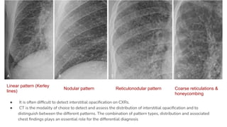 ● It is often difﬁcult to detect interstitial opaciﬁcation on CXRs.
● CT is the modality of choice to detect and assess the distribution of interstitial opaciﬁcation and to
distinguish between the different patterns. The combination of pattern types, distribution and associated
chest ﬁndings plays an essential role for the differential diagnosis
Linear pattern (Kerley
lines)
Nodular pattern Reticulonodular pattern Coarse reticulations &
honeycombing
 