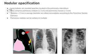 Nodular opaciﬁcation
● Lung nodules are rounded opacities located in the pulmonary interstitium.
● They comprise pulmonary nodules (≤ 3 cm) and pulmonary masses (> 3 cm).
● Nodules < 6 mm in average diameter are called micronodules according to the Fleischner Society
Glossary.
● Pulmonary nodules can be solitary or multiple
 