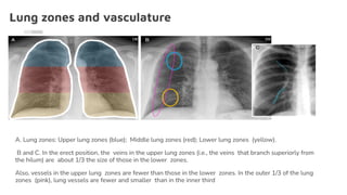 Lung zones and vasculature
A. Lung zones: Upper lung zones (blue); Middle lung zones (red); Lower lung zones (yellow).
B and C. In the erect position, the veins in the upper lung zones (i.e., the veins that branch superiorly from
the hilum) are about 1/3 the size of those in the lower zones.
Also, vessels in the upper lung zones are fewer than those in the lower zones. In the outer 1/3 of the lung
zones (pink), lung vessels are fewer and smaller than in the inner third
 