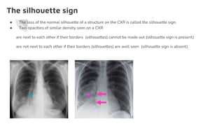 The silhouette sign
● The loss of the normal silhouette of a structure on the CXR is called the silhouette sign.
● Two opacities of similar density seen on a CXR
are next to each other if their borders (silhouettes) cannot be made out (silhouette sign is present)
are not next to each other if their borders (silhouettes) are well seen (silhouette sign is absent)
 