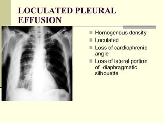 LOCULATED PLEURAL EFFUSION Homogenous density  Loculated  Loss of cardiophrenic angle  Loss of lateral portion of  diaphragmatic  silhouette  