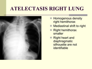 ATELECTASIS RIGHT LUNG Homogenous density right hemithorax  Mediastinal shift to right  Right hemithorax smaller  Right heart and diaphragmatic silhouette are not identifiable     