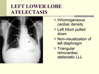 LEFT LOWER LOBE ATELECTASIS Inhomogeneous cardiac density  Left hilum pulled down  Non-visualization of left diaphragm  Triangular retrocardiac atelectatic LLL  