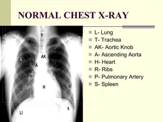 NORMAL CHEST X-RAY L- Lung T- Trachea AK- Aortic Knob A- Ascending Aorta H- Heart R- Ribs P- Pulmonary Artery S- Spleen 