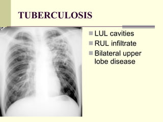 TUBERCULOSIS LUL cavities  RUL infiltrate   Bilateral upper lobe disease  