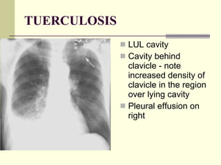 TUERCULOSIS LUL cavity  Cavity behind clavicle - note increased density of clavicle in the region over lying cavity  Pleural effusion on right  