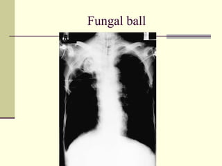 Fungal ball 