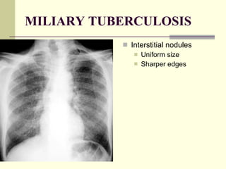 MILIARY TUBERCULOSIS Interstitial nodules  Uniform size  Sharper edges  