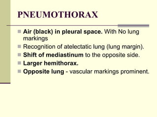 PNEUMOTHORAX Air (black) in pleural space.  With No lung markings  Recognition of atelectatic lung (lung margin).  Shift of mediastinum  to the opposite side.  Larger hemithorax.  Opposite lung  - vascular markings prominent.  