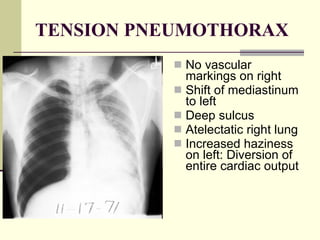 TENSION PNEUMOTHORAX No vascular markings on right  Shift of mediastinum to left  Deep sulcus  Atelectatic right lung  Increased haziness on left: Diversion of entire cardiac output  