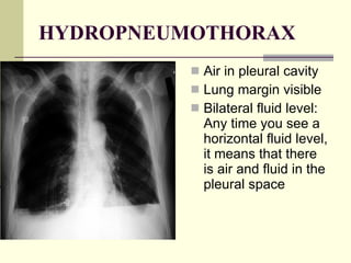 HYDROPNEUMOTHORAX Air in pleural cavity  Lung margin visible  Bilateral fluid level: Any time you see a horizontal fluid level, it means that there is air and fluid in the pleural space  