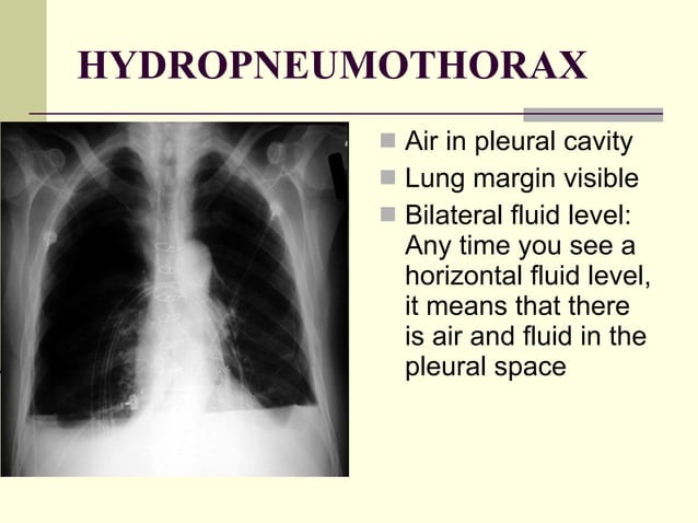 Chest x ray pathology | PPT | Lung and Respiratory Health | Diseases ...