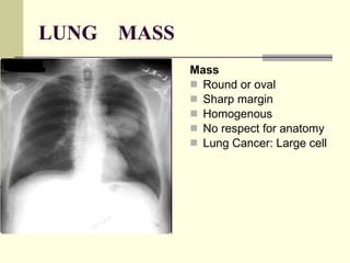 LUNG  MASS Mass   Round or oval  Sharp margin  Homogenous  No respect for anatomy  Lung Cancer: Large cell     