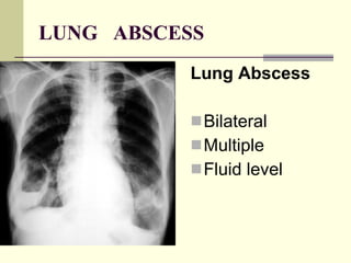 LUNG  ABSCESS Lung Abscess   Bilateral  Multiple  Fluid level  