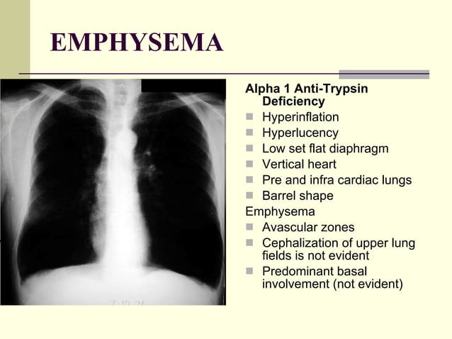 Chest x ray pathology | PPT | Lung and Respiratory Health | Diseases ...