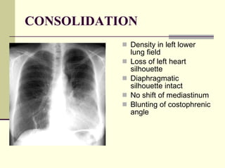 CONSOLIDATION Density in left lower lung field  Loss of left heart silhouette  Diaphragmatic silhouette intact  No shift of mediastinum  Blunting of costophrenic angle  
