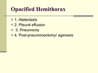 Opacified Hemithorax   1. Atelectasis  2. Pleural effusion 3. Pneumonia  4. Post-pneumonectomy/ agenesis 