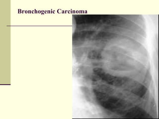Bronchogenic Carcinoma 