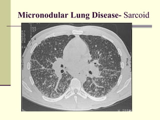 Micronodular Lung Disease-  Sarcoid  